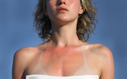 Sơ cứu khi bị cháy nắng, tránh biến chứng nguy hiểm cũng như mang lại tính thẩm mỹ cho làn da