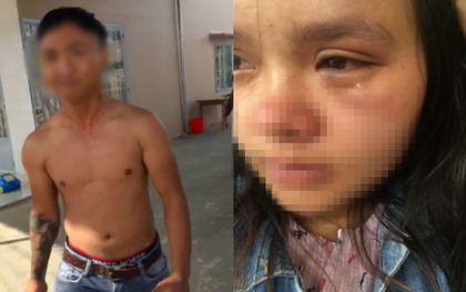Bầu vượt mặt 9 tháng, người vợ trẻ phải livestream vì bị chồng đánh tới tấp, bầm tím mắt do nằm nghỉ không trông con