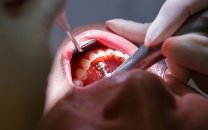 Dấu hiệu bệnh nướu răng không nên bỏ qua