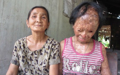 Nghẹn lòng ước mơ của bé gái bị tình địch của mẹ tạt a-xít mù hai mắt