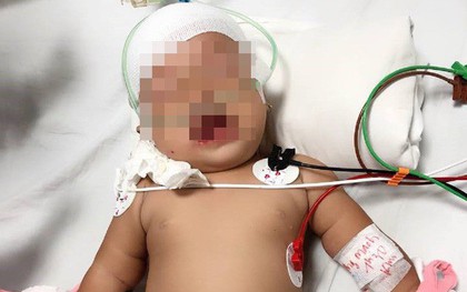 TP.HCM: Kinh hoàng bé gái 14 tháng tuổi bị khỉ nhà hàng xóm cắn rách đầu, lún sọ