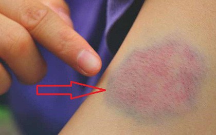 Xử lý những vết bầm tím trên da đúng cách, kịp thời phát hiện những căn bệnh nguy hiểm