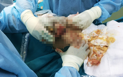 Sang Thái Lan bơm “mỡ nhân tạo”, nữ Việt kiều bị hoại tử ngực nặng