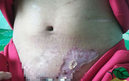 Vụ cô gái nghi bị tra tấn dã man: Sau nửa tháng đánh đập, nạn nhân phát hiện bị sẩy thai