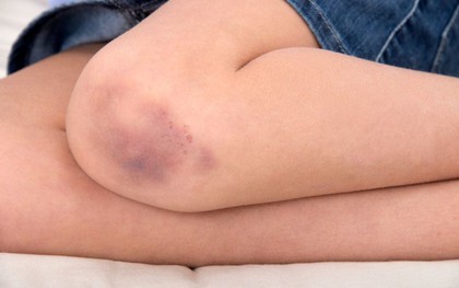 Những mẹo cực đơn giản để chữa các vết bầm do thường xuyên té ngã