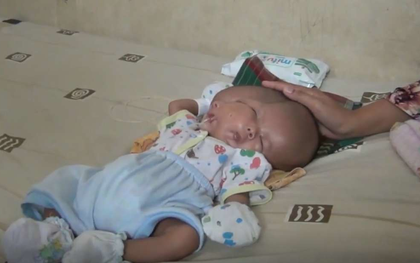 Bé trai Indonesia mắc dị tật hiếm gặp nhất: sinh ra với 2 khuôn mặt và 2 bộ não