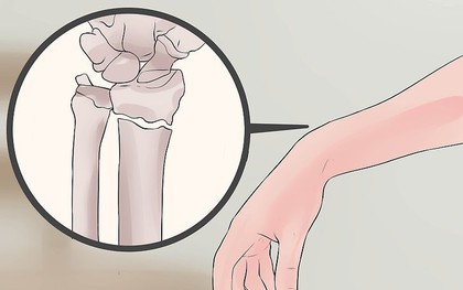 Cách chính xác nhất phân biệt bong gân cổ tay và gãy xương cổ tay để xác định cần phải nhập viện hay không