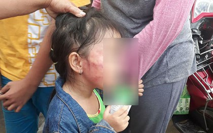 TP.HCM: Bé gái 5 tuổi nghi bị bảo mẫu tát liên tục đến sưng mặt, dọa lấy kéo cắt lưỡi nếu nói cho gia đình biết
