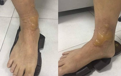 Đi massage chân, một nam giới nhập viện vì bỏng phức tạp