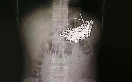 Trung Quốc: Nhập viện vì đau bụng dữ dội, bác sĩ phát hiện bệnh nhân đã nuốt đến 87 cây đinh sắt