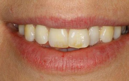 Biểu hiện lạ của răng miệng có thể cảnh báo những căn bệnh tiềm ẩn bên trong