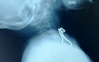 Nghệ An: Cầm móc sắt chơi rồi nuốt vào miệng, bé trai 26 tháng tuổi thủng thực quản