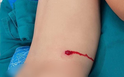 Bé trai bị đạn súng hơi của cậu xuyên thủng lưng