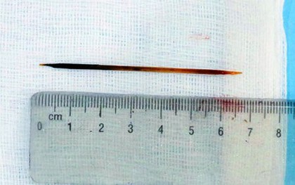 Người đàn ông ở Nghệ An nuốt phải tăm dài 7cm vì… ngủ quên