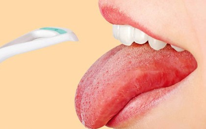 Những triệu chứng bất thường ở lưỡi có thể cảnh báo bạn đang mắc các căn bệnh nguy hiểm