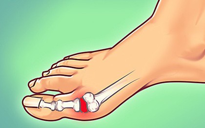 Sự thật: ngày càng nhiều người bị gout và đây là cách để hạn chế những cơn đau kinh khủng ấy