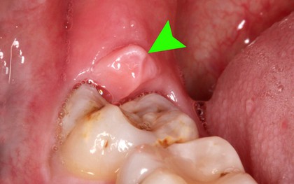 Đây là 4 thời điểm tuyệt đối không được nhổ răng khôn kẻo gây biến chứng nguy hại tới sức khỏe