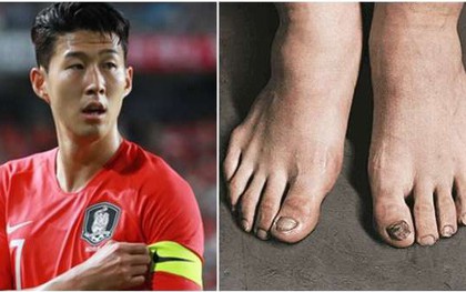 Bàn chân Son Heung-min “tan nát” sau suất miễn nghĩa vụ quân sự