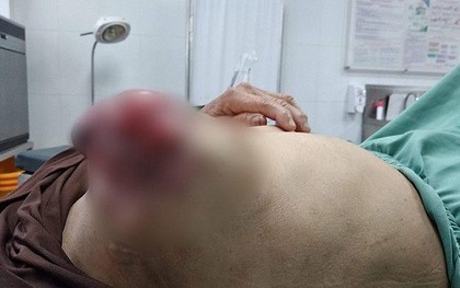 Đắp lá chữa u vú suốt 3 năm, người phụ nữ gánh hậu quả đau lòng