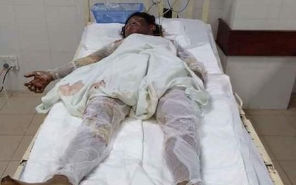 Ngăn vợ tự tử bằng xăng, 3 người trong gia đình bị bỏng nặng