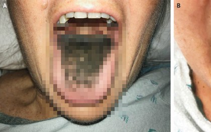 "Lông mọc trong lưỡi" - căn bệnh cực hiếm chứng minh rằng chuyện quái gì cũng có thể xảy ra
