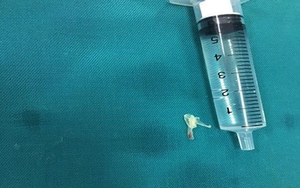 Bé trai 10 tháng tuổi ở Nghệ An hóc xương cá gần 1 cm