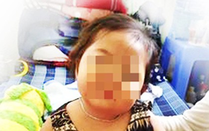 Bé gái 32 tháng tuổi nhiễm trùng nặng sau tiêm ngừa và con số báo động: 55% nhân viên y tế tại Việt Nam chưa biết tiêm an toàn
