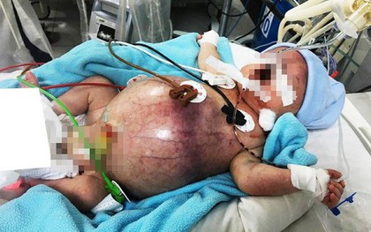 Tưởng không thể qua khỏi, bé trai thủng ruột từ trong bụng mẹ được cứu sống kỳ diệu