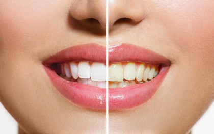 Đánh răng mỗi ngày nhưng răng ngày càng vàng ố xỉn màu có thể do 5 sai lầm ai cũng dễ mắc phải sau