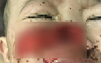 Hãi hùng bé trai bị chó cắn đứt rời... mũi