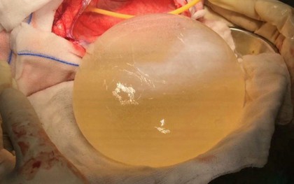 Liên tục nhức đầu, thậm chí liệt nửa người, 2 năm sau, bệnh nhân sợ hãi khi bác sĩ phát hiện thứ kinh khủng này trong não
