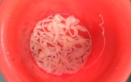 Hãi hùng sán xơ mít dài 9m trong bụng nam thanh niên