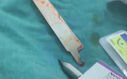 Gắp lưỡi dao Thái Lan găm trong phổi bệnh nhân suốt 10 ngày