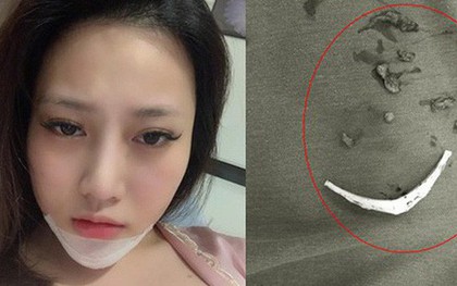 Từ trường hợp tháo độn cằm do tiêm filler, cùng nhìn lại và rút ra bài học sau vô số ca biến chứng