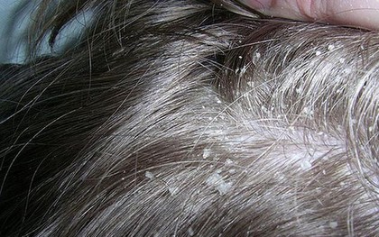 Những nguyên nhân không ngờ gây ra tình trạng nấm da đầu mà nhiều người không hề nghĩ tới