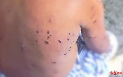 Ông bố làm đồng mãi chưa về, gia đình lo lắng đi tìm thì phát hiện bất tỉnh giữa đường và khiếp sợ trước vết thương do ong tấn công