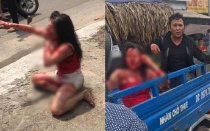 Cô gái bị rạch mặt dã man: Chồng hờ xuống tay tàn nhẫn vì níu kéo tình cảm bất thành