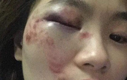 Hà Nội: Nữ nhân viên xe buýt tố bị nhóm thanh niên hành hung vào đúng ngày 20/10, phải nhập viện cấp cứu