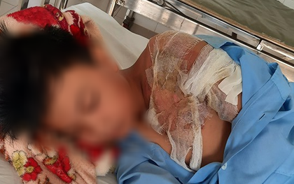 Xác minh thông tin bé trai ở Long An bị cha đẻ bạo hành, đổ nước sôi khiến bỏng nặng phải nhập viện
