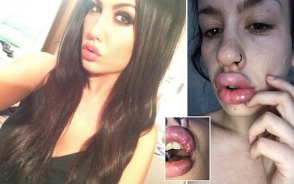 Thích môi tều như Kylie Jenner, người phụ nữ trẻ đi tiêm chất làm đầy giá rẻ và hậu quả khiến cô vô cùng hối hận