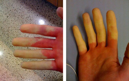 Cẩn thận với căn bệnh thường gặp phải khi trời lạnh khiến ngón tay và ngón chân của bạn đổi màu trắng xanh