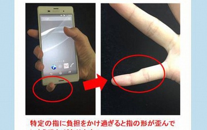 Ngón tay cong vẹo, biến dạng: tình trạng dễ thấy ở những người dùng điện thoại quá lâu, quá nhiều