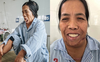 Phép màu đến với người phụ nữ bị bỏng nặng, 50 năm không ngậm được miệng: Cuối cùng, Sáu đã có thể cười!