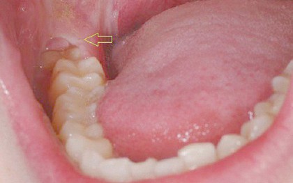 Đây là những cách hữu hiệu giúp bạn giảm bớt cơn đau khi mọc răng khôn