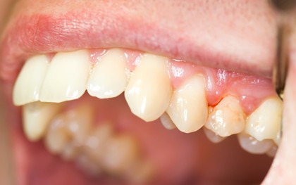 Có thể bạn đã mắc bệnh viêm nướu răng nếu gặp phải một trong các vấn đề sau
