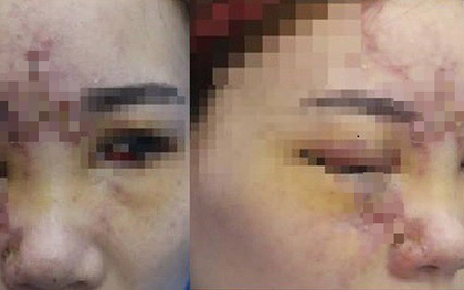 Liên tiếp mù mắt sau tiêm filler không đúng chỗ