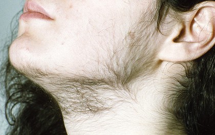 Nhiều mụn, nhiều ria mép hay rối loạn kinh nguyệt ở nữ giới có thể là do thừa testosterone (hormone nam)
