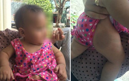 Đồng Nai: Bé gái 8 tháng tuổi bị bố mẹ bỏ rơi, nghi bị người nhận nuôi đánh bầm tím khắp người