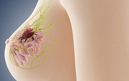 Có tới 4 loại u vú lành tính mà nữ giới hay gặp nhưng nên chữa trị từ sớm để ngăn ngừa nguy cơ phát triển thành ung thư vú