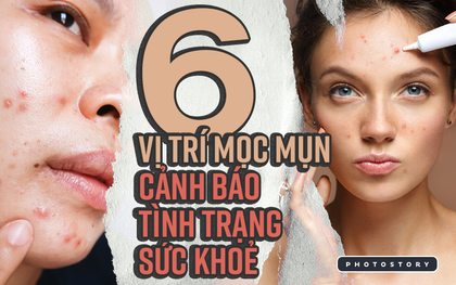 Đằng sau 6 vị trí mụn này là những dấu hiệu cảnh báo tình trạng sức khỏe của cơ thể